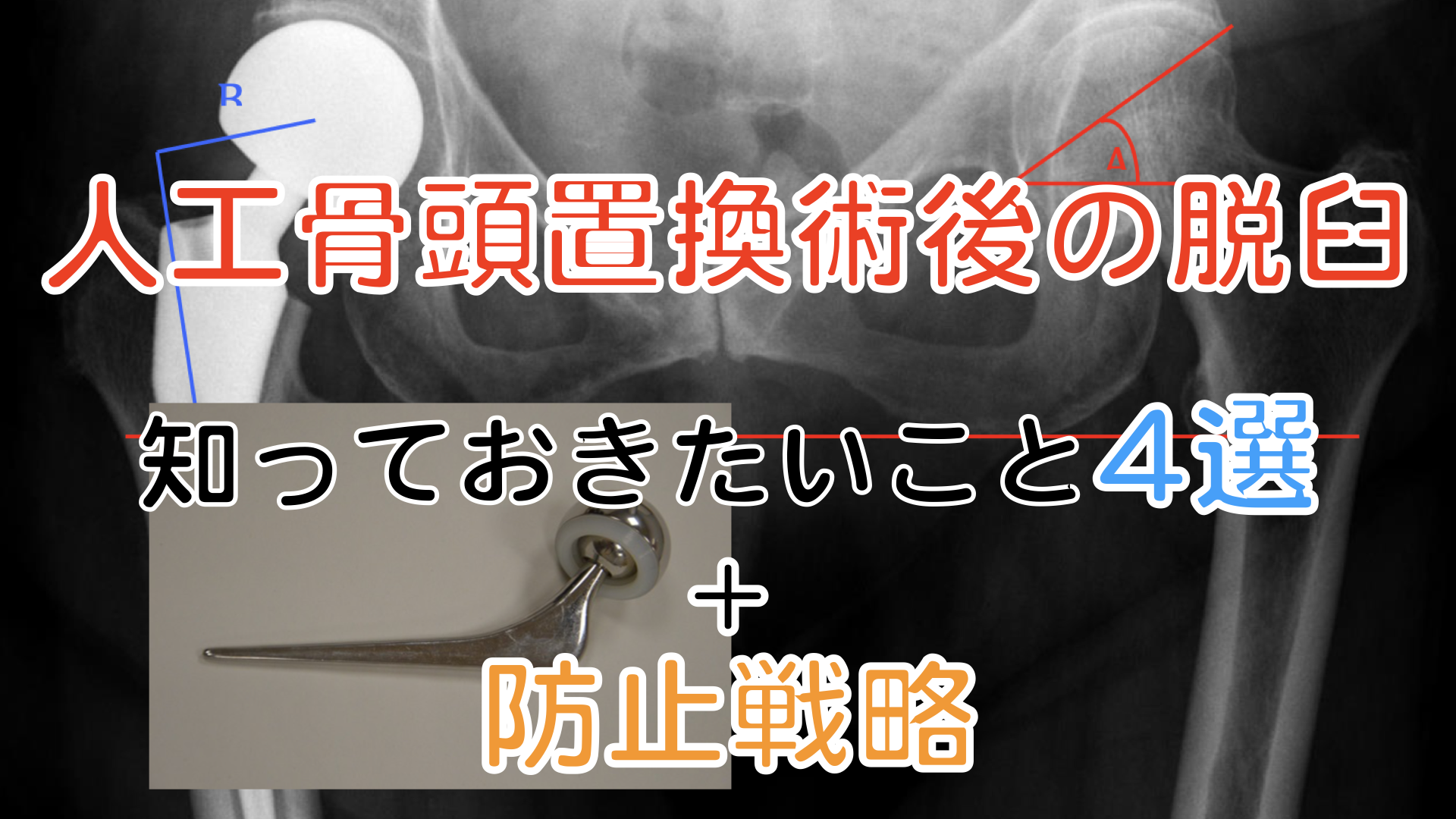 関節置換手術が必要になるのはどのような場合ですか?